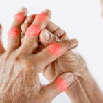 Take a Proactive Approach to Arthritis Pain with Physical Therapy